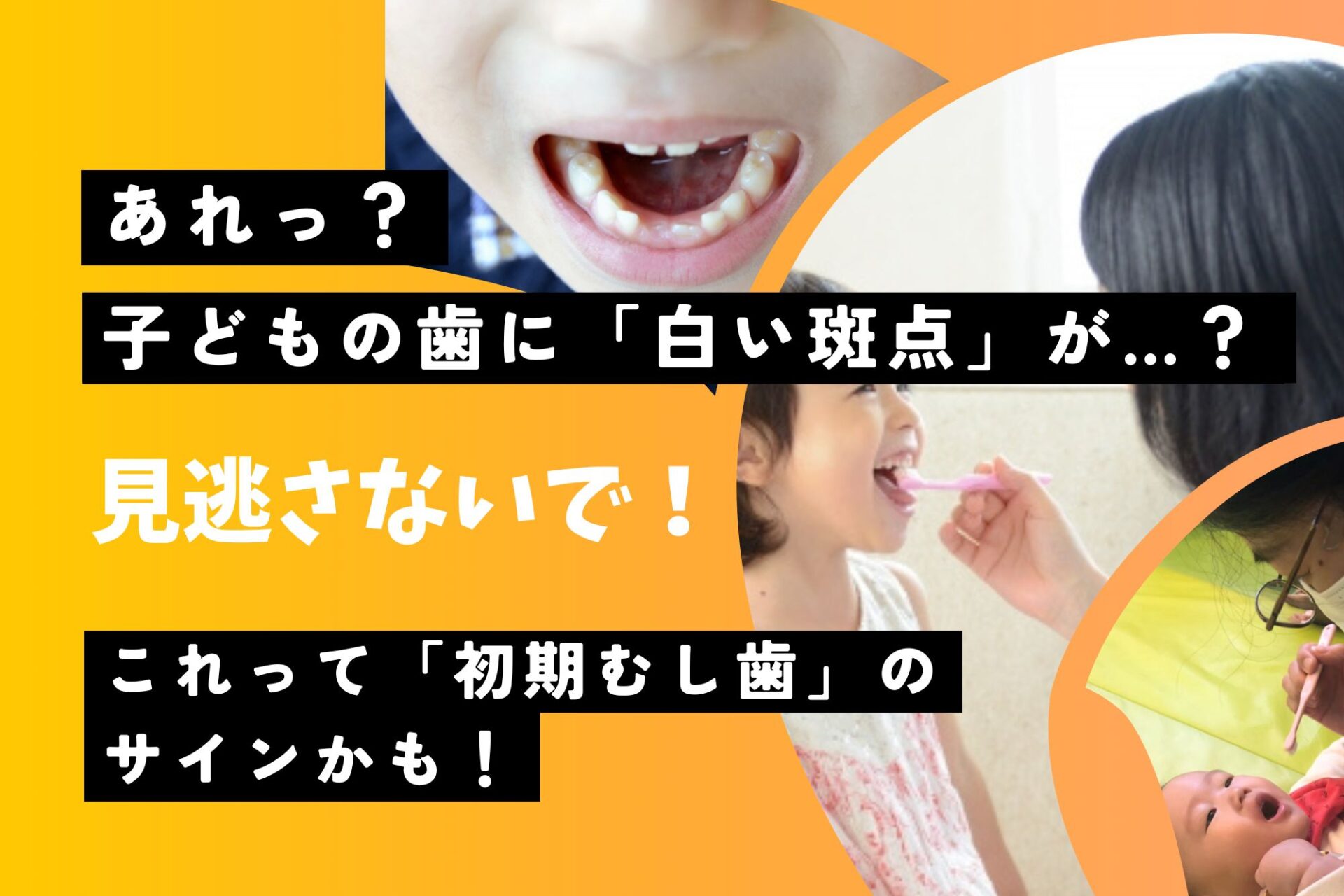 子どもの歯に白い斑点が！これって初期「むし歯」のサインかも【草津小児歯科・かがやき歯科クリニック】」